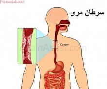 چای داغ,سرطان مری,آسیب دیدن بافت مری,shabnamha.ir,شبنم همدان,afkl ih