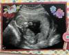 دغدغه جدید مادران باردار تهیه آلبوم جنین شده است