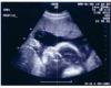  سونوگرافی های غیرضروری به سلامت جنین لطمه می زند