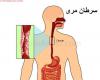 چای داغ,سرطان مری,آسیب دیدن بافت مری,shabnamha.ir,شبنم همدان,afkl ih